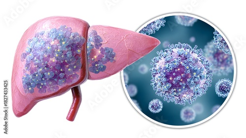 Human Liver with Viral Infection and Microscopic View of Viruses.