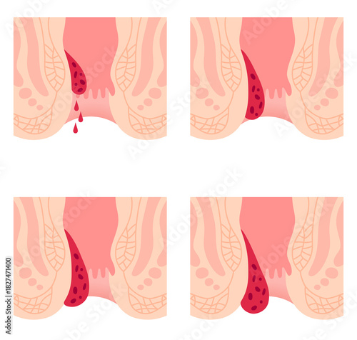 内痔核の進行度　内痔核Ⅰ～Ⅳ度　肛門の病気