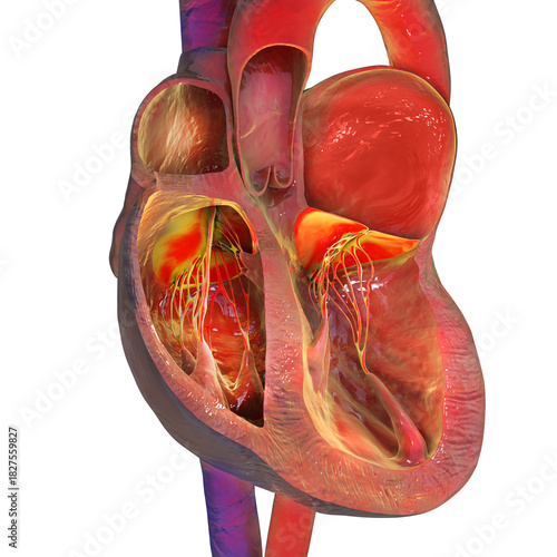 Left atrial enlargement, 3D illustration