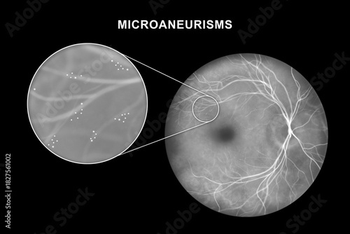 Retina with microaneurysms, illustration in fluorescein angiography style