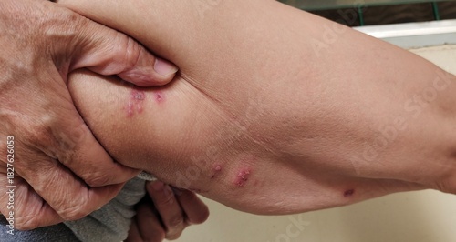 portrait showing the herpes and blistering, inflammation skin and scar, scratch and sadness, health care and medical concept.