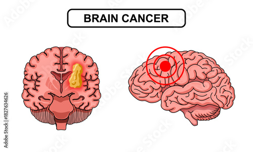 Brain tumor illustration. Human brain cancer, glioma, tumor in human brain tissue. Cancer cell structure. Vector illustration for medical, scientific, and educational purposes.
