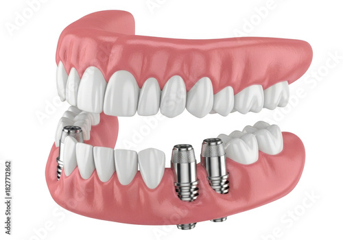 Realistic dental implants and dentures on a transparent background isolated on transparent background