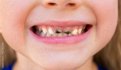 Φωτογραφία Children's teeth with caries