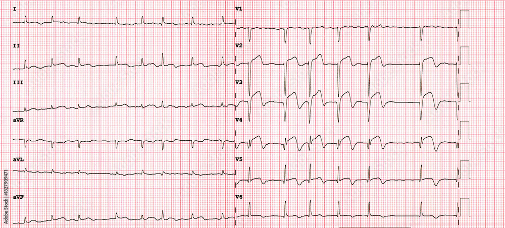 Naklejka premium Acute Anterior Myocardial Infarction ECG with Ventricular Tachycardia Complication STEMI Medical Emergency Cardiology Diagnostic
