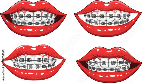 Smiling Mouth with Metal Dental Braces Orthodontic Correction Treatment Process Perfect Teeth Alignment Healthy Smile Lips Vector.