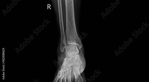 Ankle x-ray showing tibia, fibula and ankle joint. AP view plain film radiograph for diagnostic examination of ankle anatomy and bone structure alignment