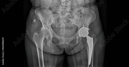 Pelvis x-ray showing  total hip replacement with prosthetic implants. AP view radiograph for postoperative examination of hip arthroplasty hardware