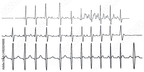 Three electrocardiogram traces displaying different heart rhythms and irregularities