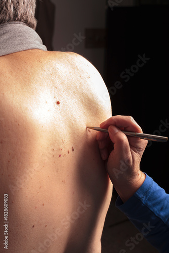 Obraz na plátně Close-up of a dermatologist examining a patient with warts on their back, cance