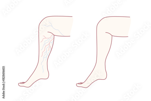 visible varicose veins on leg, clinical illustration highlighting superficial veins and inflamed vessels,