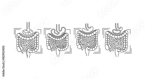 Four stage diagram illustrating progression of inflammatory bowel disease in human large intestine