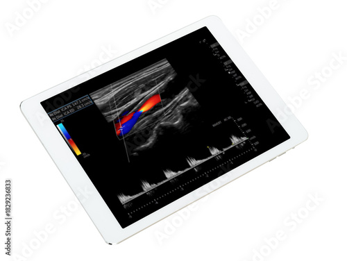 Contemporary medical imaging: An ultrasound of the carotid artery displayed on a sleek tablet, highlighting the integration of technology in health diagnostics