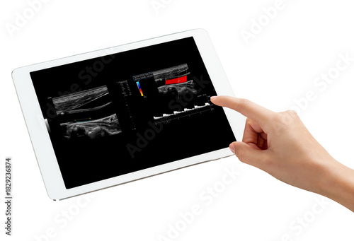 Contemporary medical imaging: An ultrasound of the carotid artery displayed on a sleek tablet, highlighting the integration of technology in health diagnostics