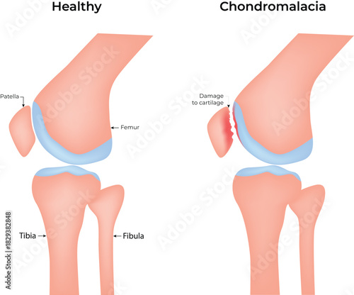Comparison of Healthy Knee and Chondromalacia Patella Vector Illustration