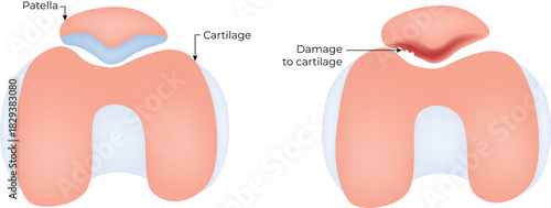 Knee Cartilage Damage Comparison Vector Illustration