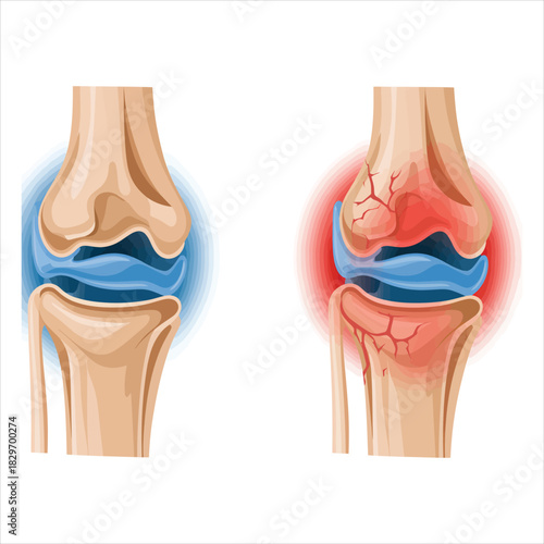 Healthy knee joint contrasts inflamed version, showcasing bone structure and cartilage clarity on white
