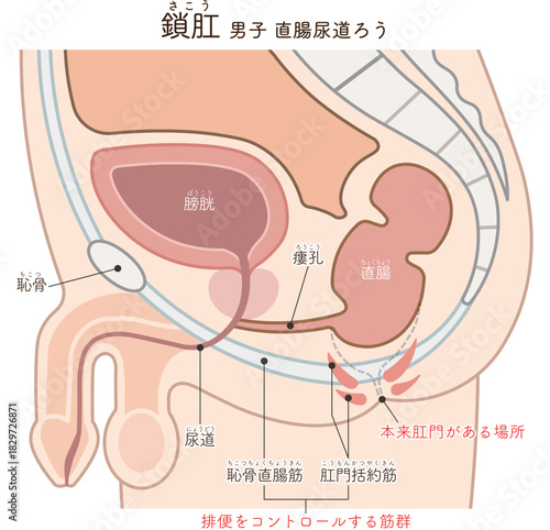 男性の鎖肛　直腸尿道ろう　imperforate anus(ARM) illustration