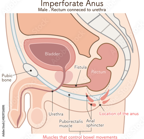 男性の鎖肛　直腸尿道ろう　imperforate anus(ARM) illustration