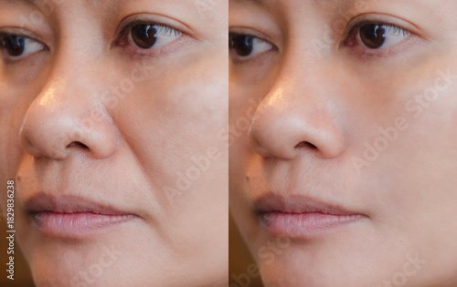 Before and after comparison of an Asian woman receiving dermal filler treatment for marionette lines. Concept for cosmetic procedures, facial rejuvenation, anti-aging, and aesthetic medicine.