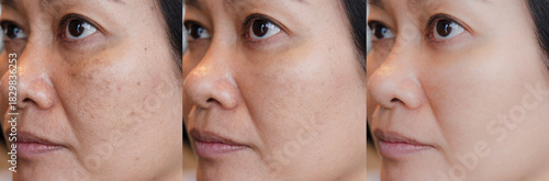 cropped Image before and after spot melasma pigmentation treatment on skin face asian woman compare in 3 development periods. Skincare and beauty concept	