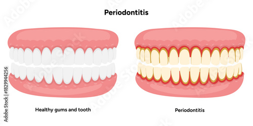 Hand-drawn dental illustration showing comparison between healthy teeth and teeth affected by periodontal problems. Includes gum inflammation, plaque buildup, and root exposure