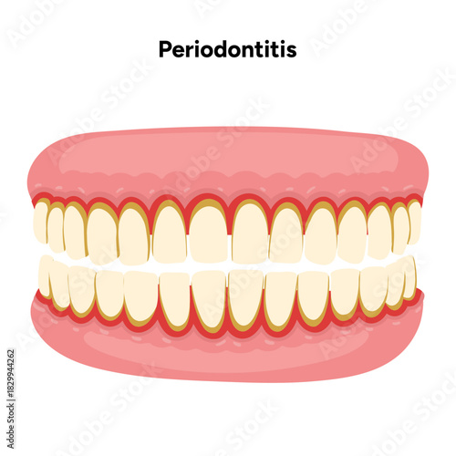 Hand-drawn dental illustration showing teeth affected by periodontal problems, including gum inflammation, plaque buildup, and root exposure. Educational and professional visual for dental 