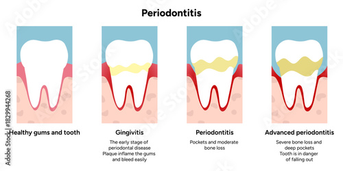 Hand-drawn dental infographic tooth anatomy with stages of periodontal disease gums, roots, and supporting structures.  Dental education and professional dentistry content