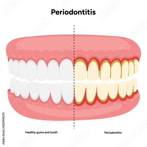 Hand-drawn dental illustration showing comparison between healthy teeth and teeth affected by periodontal problems. Includes gum inflammation, plaque buildup, and root exposure