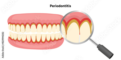 Hand-drawn dental illustration showing teeth affected by periodontal problems, including gum inflammation, plaque buildup, and root exposure. Educational and professional visual for dental zoom
