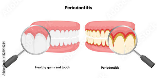 Hand-drawn dental illustration showing comparison between healthy teeth and teeth affected by periodontal problems. Includes gum inflammation, plaque buildup, and root exposure zoom