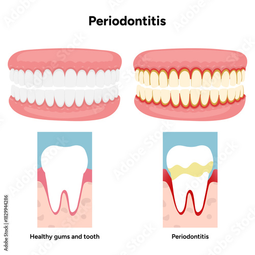 Hand-drawn dental illustration showing comparison between healthy teeth and teeth affected by periodontal problems. Includes gum inflammation, plaque buildup, and root exposure and tooth anatomy