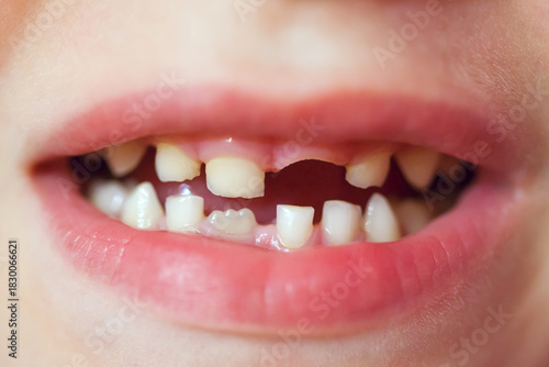 Close up child caries
