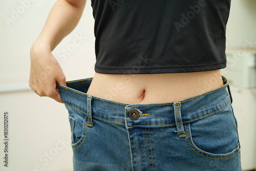 Asian woman with cellulite on leg skin fat, overweight problem.