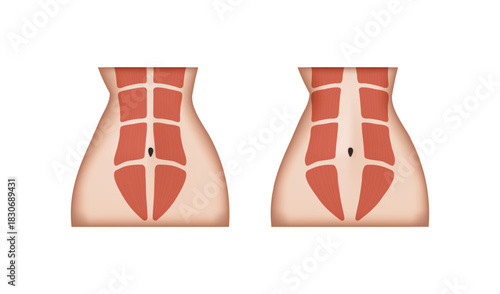 Diastasis recti, normal abdominal muscles and separated abdominal muscles