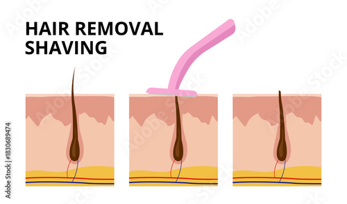 Hair follicle before, during and after shaving with razor blade
