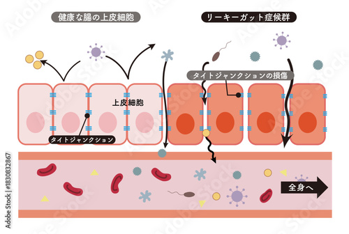 リーキーガット症候群をわかりやすく表した小腸上皮細胞の断面図