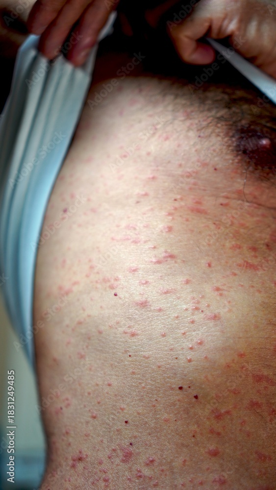Naklejka premium Man is lifting his shirt, revealing his torso covered with a reddish widespread skin rash, possibly shingles, indicating a skin condition or illness