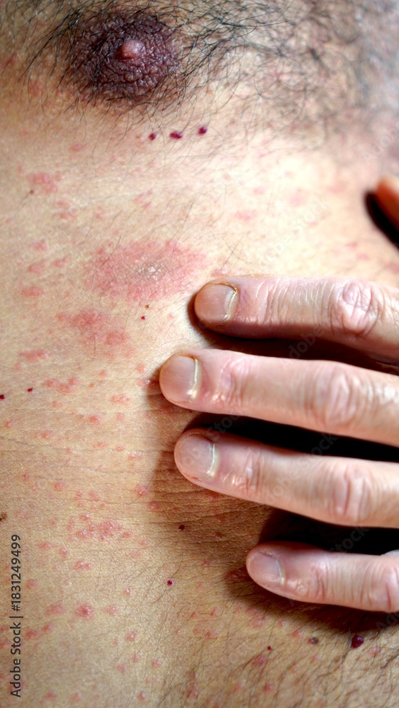 Obraz premium Human chest and abdomen with skin presenting a rash and irritation, a person's hand touching the affected area, illustrating concepts of dermatology, illness, and health issues