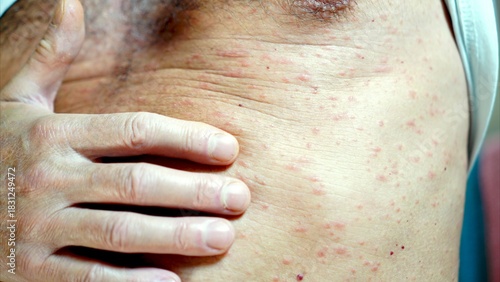 Man experiencing an uncomfortable irritating skin rash on his body, a visible symptom of a skin condition or allergic reaction requiring medical attention and treatment