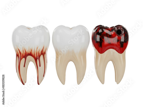 Three molar tooth models showing progression from healthy to severe decay and gum bleeding, isolated on transparent background