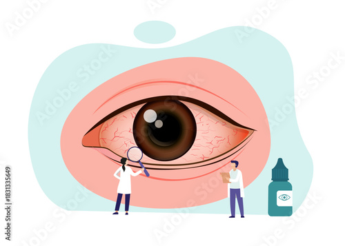 Illustration of inflammation of the inner lining of the eyelid or Conjunctivitis