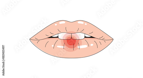 An illustration of a pair of human lips with a prominent red sore or cold sore in the center, indicating discomfort or an infection.