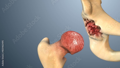 Medical Visualization of Hip Dysplasia Impacting Leg Bone