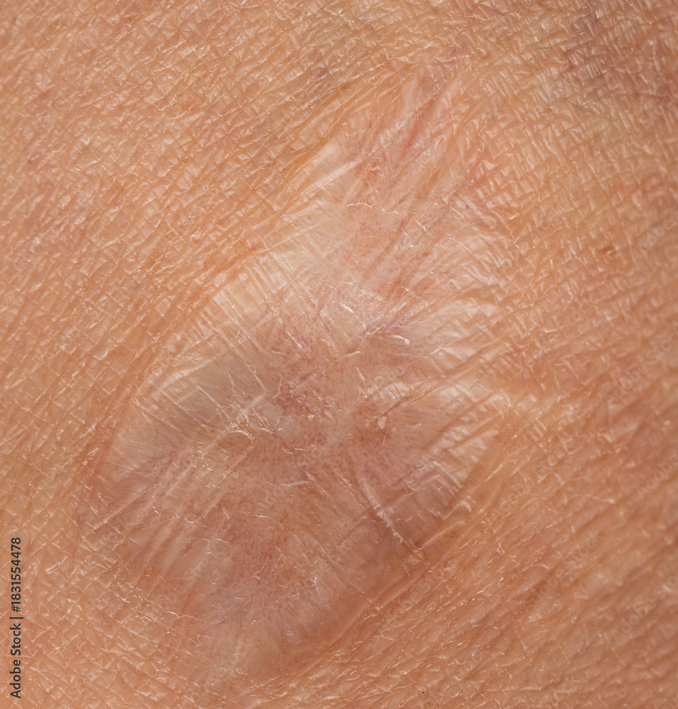 Fototapeta premium scar on the skin of the leg as a background.