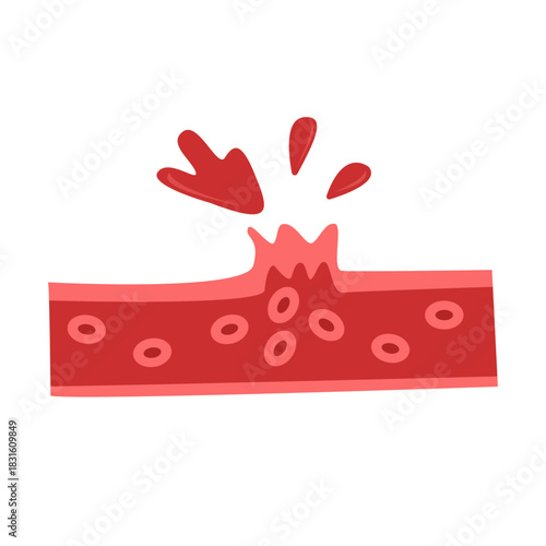 Cholesterol Buildup in Blood Vessel