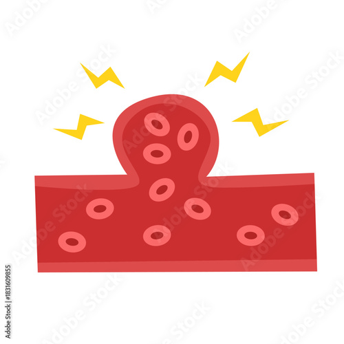 Cholesterol Buildup in Blood Vessel