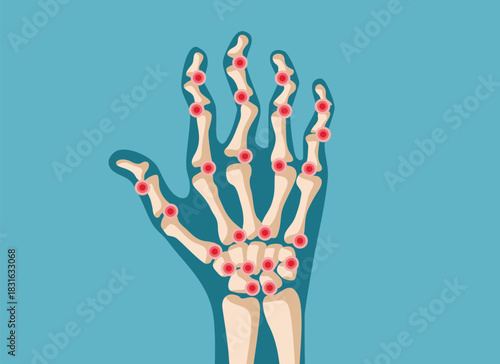 Hand of a Person Suffering from Arthritis Vector Illustration. Elderly patient with swelling and tenderness the arm joints 