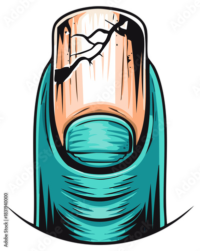 Cartoon illustration of a cracked fingernail with turquoise digit and cuticle, damaged and broken.