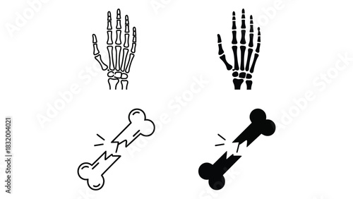Hand bones skeleton fracture medical illustration vector art